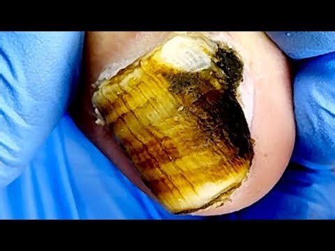 Half Of My Toenails Are Moldy, Trim Them Step By Step!【Xue Yidao】