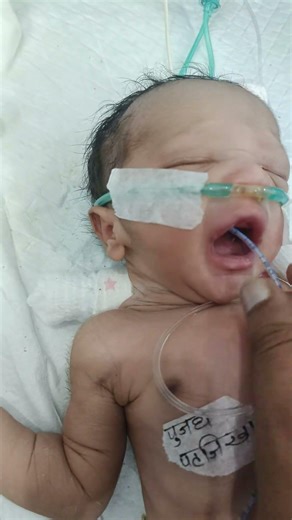 How to Insert an NG Tube in a Premature Baby. #PrematureBaby #NGTubeInsertion #BabyCare #InfantCare