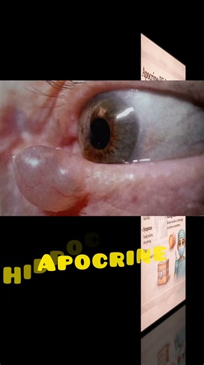 Apocrine Hidrocystoma #ophthalmology #optometry #learningoptometrywithkeertika