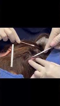 CUTE LITTLE CYSTS ON THE SCALP - CYST SCALP REMOVAL - REMOVING CYSTS ON THE SCALP