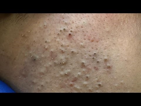 Daily Skincare Routine | Deep Cleansing & Blackhead Removal