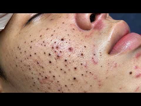 Extreme Blackhead Removal #1 | Satisfying Pimple Pop & Deep Skin Cleaning #Blackheads