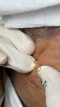 Removing a Years-Old Giant Blackhead #blackheads #acne #shortvideo #skincare