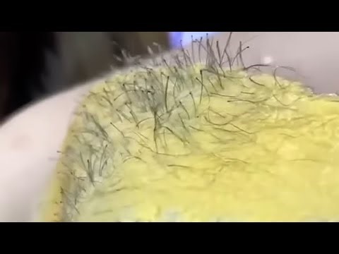 Brazilian hair leg sugaring sugarwaxing for beginners(24)#waxing#viral#brazilian#sugaring#wax