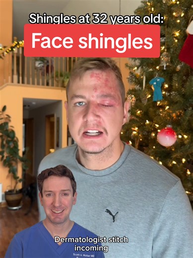 Recognizing Shingles Early Around the Eyes