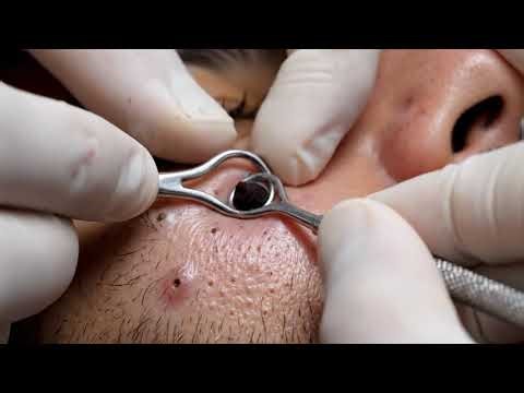 Satisfying Pimple Popping | Deep Acne Removal Compilation