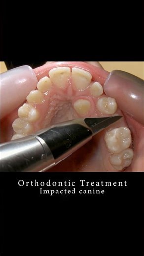 Braces can change your smile - Surgical exposure of Hidden tooth #braces #orthodontist #dentist