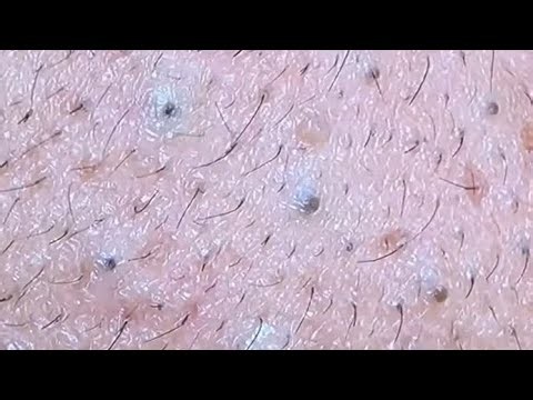 Best Satisfying Pimples Popping Cyst Removal Acne Blackheads Explosive Compilation Videos #313