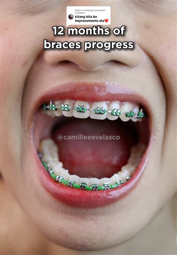 2025 Braces Progress: What's Changed?
