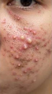 Extreme Acne Extraction #22
