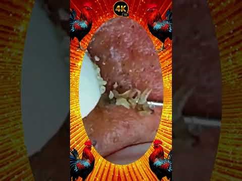 Blackheads Removal #374 | Acne Treatment and Very Satisfying Satisfying Pimple pop #blackheads
