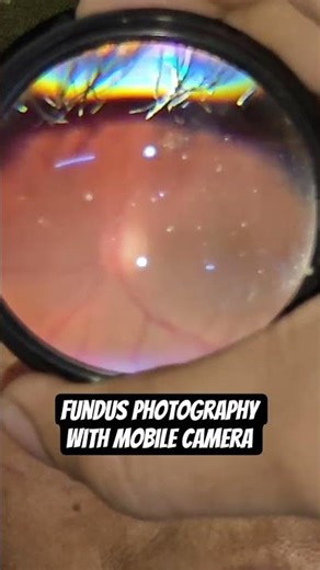 FUNDUS PHOTOGRAPHY WITH MOBILE CAMERA | RETINA