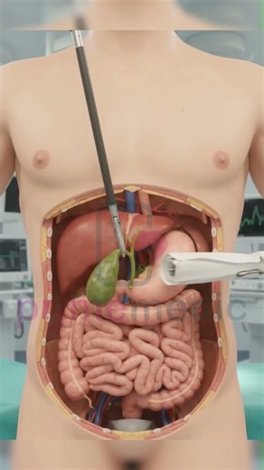 How Keyhole Gallbladder Removal Works | Cholecystectomy Explained