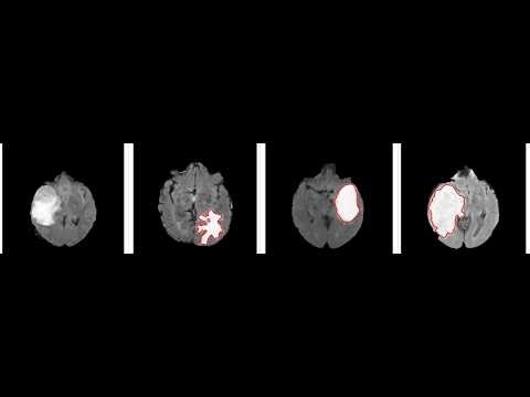 Brain Tumor Classification Part 1