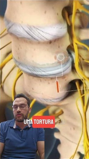 Hérnia de disco, como descomprimir os nervos - FisioPrev