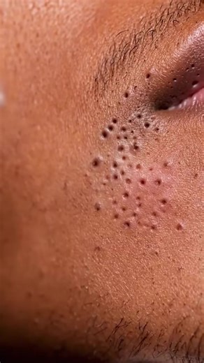 Extreme Vacuum Blackhead Removal | Dr. Mandy