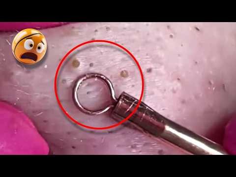 Unbelievable Pimple Popping Video | Huge Blackhead Extraction 😱😱