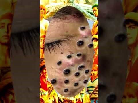 Blackheads Removal #220 | Acne Treatment and Very Satisfying Satisfying Pimple pop #blackheads