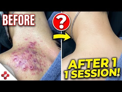 Severe Acne Treatment Guide | How to Handle Cystic Breakouts