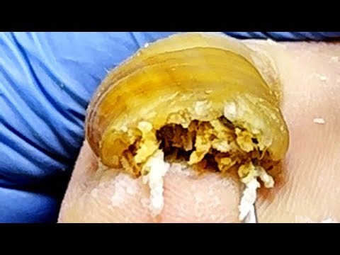 Extremely Thick Onychomycosis Should Be Trimmed Very Carefully!【Xue Yidao】