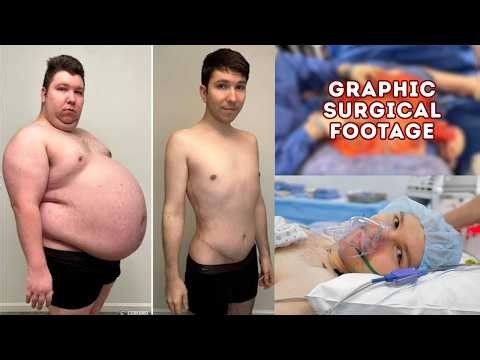 GRAPHIC - Nikocado Avocado's Full Skin Removal Plastic Surgery