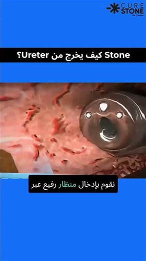 Ureteric Stone Removal with Basket | إزالة الـ Ureteric Stone باستخدام السلة |RIRS Animation #shorts