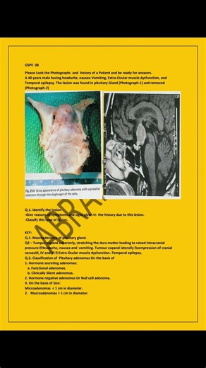 👉 Endocrine Module Part 1 OSPE | LUMHS MBBS 🔥