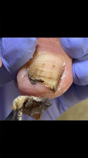 Satisfying Pedicure Video! #pedicure #toenails