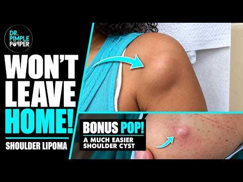 How To Handle a Lipoma That Didn't Want to Leave | Dr. Pimple Popper | PLUS a bonus shoulder pop!