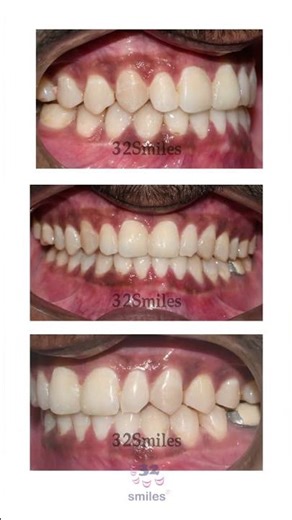 Real Patient Crossbite Correction Using Clear Aligners Before After ✨ class III correction