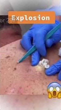 Removing large blackheads and pimples from face new 2026 #104