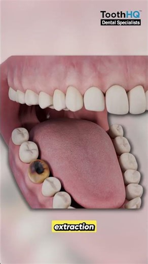 What are the risks of delaying a tooth extraction?