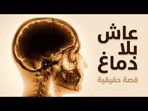 44 عاماً بلا دماغ — قصة حقيقية من مجلة ذا لانسيت