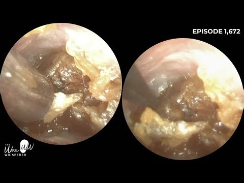 1,672 - Chronic Otomycosis (Fungal Ear Infection) | Endoscopic Ear Wax Removal