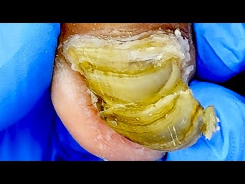 Thick Green Toenails, Cut Off The Fungus Layer By Layer【Podiatry Clinic】