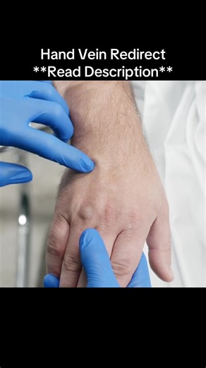 Anchoring a Rolly Hand Vein for IV Insertion