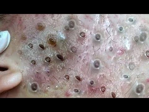 Most Satisfying Blackhead Extraction Compilation 2026 #15