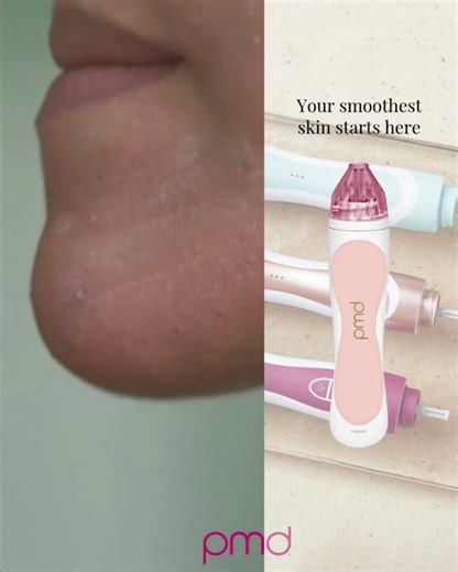 At-Home Microdermabrasion for Glowing Skin