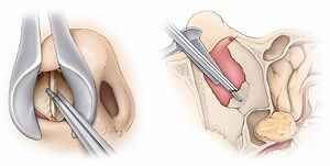 Transsphenoidal Surgery | Expert Surgeon | Aaron Cohen-Gadol, MD