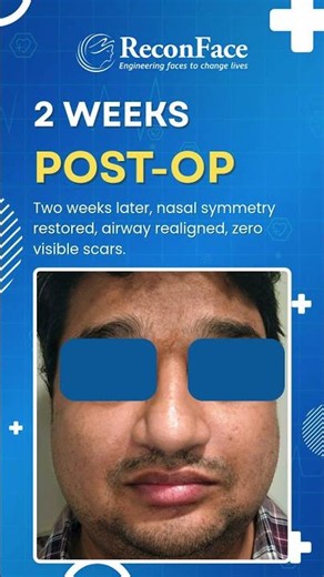 Broken Nose Fixed Without Open Surgery | Closed Reduction Technique #Reconface