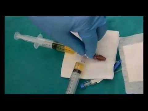 Disostruzione Accesso Venoso