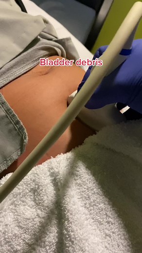 Bladder Debris on Ultrasound: Identification & Interpretation