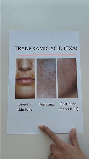 Tranexamic Acid | TXA #tranexamicacid #skincareeducation #darkspots #skincareingredient