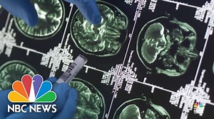 Experts unsure about use of at-home brain zapping treatments - The Global Herald