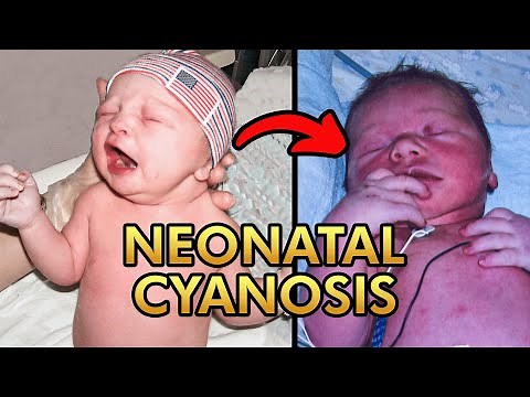Neonatal Cyanosis: Pathophysiology, Types, Differential Diagnosis and Treatment