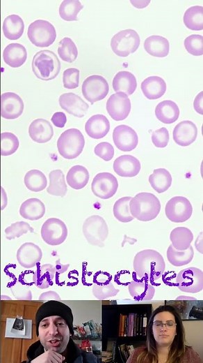 Schistocytes vs Acanthocytes vs Echinocytes