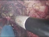 TAMIS Proctectomy with Turnbull-Cutait Pull-Through Coloanal Anastomosis for Rectourethral Fistulas • Video • MEDtube.net