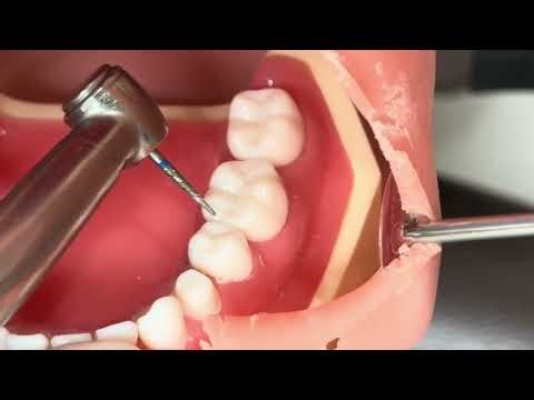 [Lower left molar inlay formation] (1/11) Explanation of inlay formation