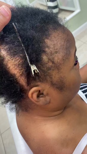 #fyp #foryou #alopecia #alopeciabraids #miamibraider #hair #hairtutorial