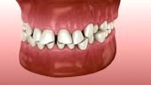 Dental attrition resulting in loss of tooth tissue. Medically...